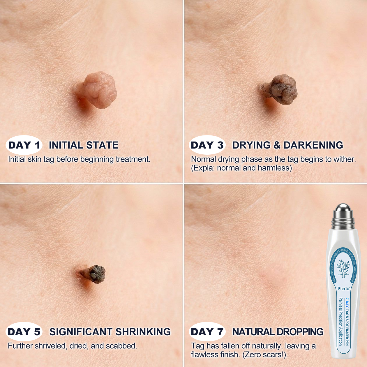 𝐏i𝐜𝐝o®🩹7-𝐷𝑎𝑦 𝗧𝐚𝐠 & 𝗦𝗽𝐨𝐭 𝐄𝐫𝒂𝒔𝒆𝒓(Zero Pain, Zero 𝐒𝐜𝐚𝒓𝒔 Rollerball)💪