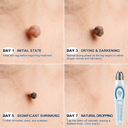 𝐏i𝐜𝐝o®🩹7-𝐷𝑎𝑦 𝗧𝐚𝐠 & 𝗦𝗽𝐨𝐭 𝐄𝐫𝒂𝒔𝒆𝒓(Zero Pain, Zero 𝐒𝐜𝐚𝒓𝒔 Rollerball)💪